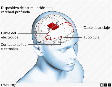 cartoon po r n|Epilepsia: cómo funciona el dispositivo implantado por primera .